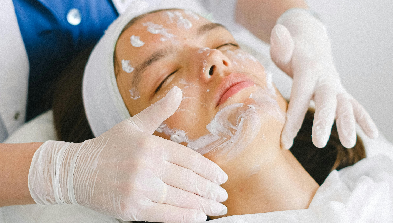 Chemical Peel